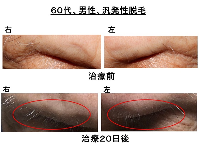 円形脱毛症　病院